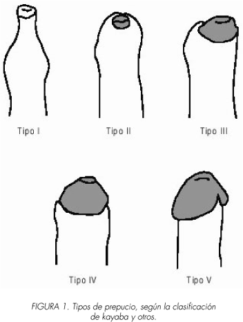 Tipos de prepucios