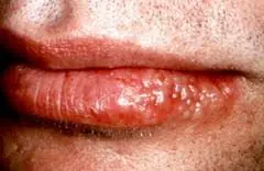 Tratamiento Herpes Labial