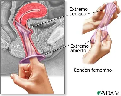 Anillo vaginal anticonceptivo