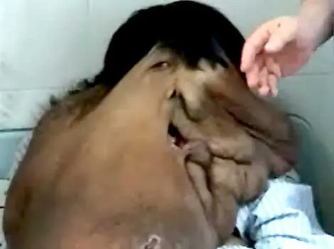 Hombre Elefante (elefantiasis) ayudemos al TOP