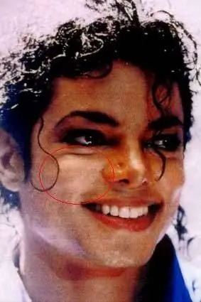 Qué es el Vitiligo.