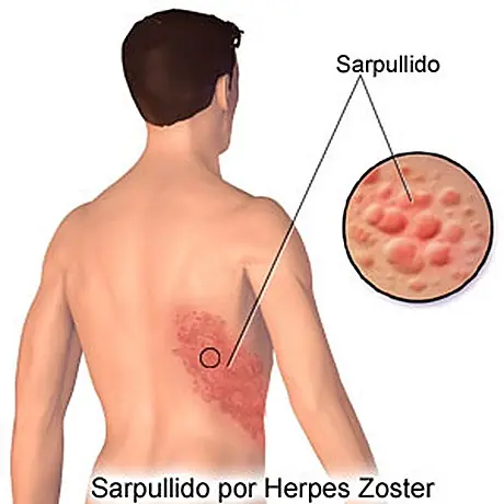 Herpes zoster