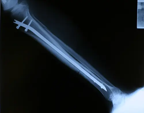 Fracturas de Tibia y Perone