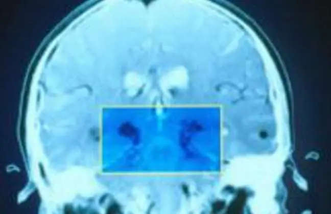 Computadoras para detectar el Parkinson