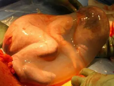 Bebe nace dentro de saco amniotico