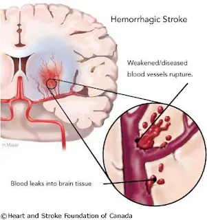 ACV: ataque cerebro vascular