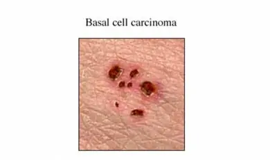 Los Cancer mas comunes.