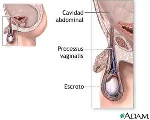 Torsión testicular ¿que es?