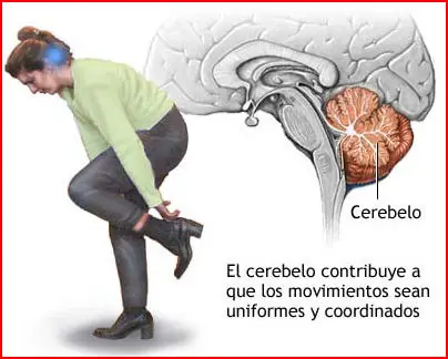 Sabes lo que es la Ataxia