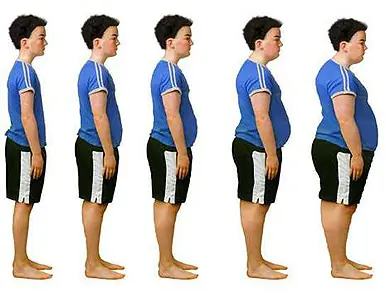 la obesidad