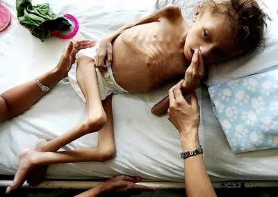 Más de 450 millones de menores padecen malnutrición