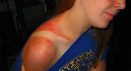 Las Quemaduras de Sol: Solucionado