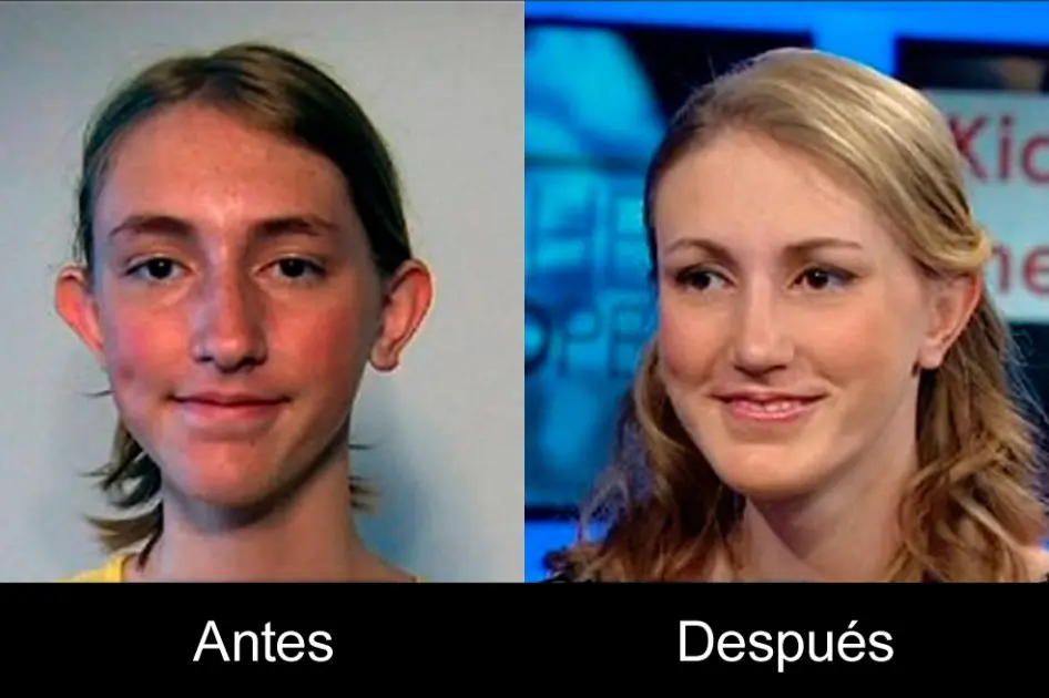 Con 14 años, se realizo 3 cirugias plasticas