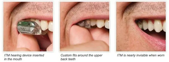 Un audífono dental - SoundBite