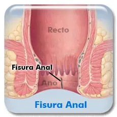 Fisura Anal