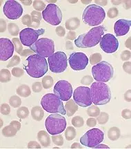 Leucemia una enfermedad letal