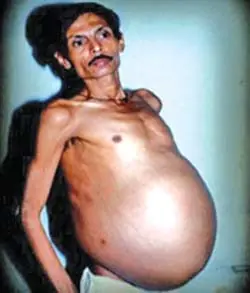 Hombre embarazado