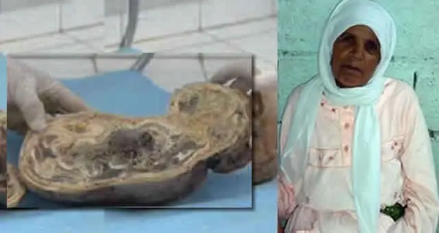 Embarazada de una piedra durante 46 años.