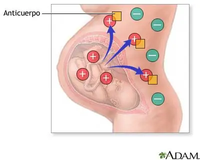 El Factor Rh y sus complicaciones