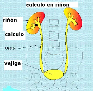 ¿calculos es los mismo que piedras?