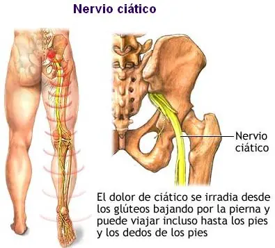 Ciática