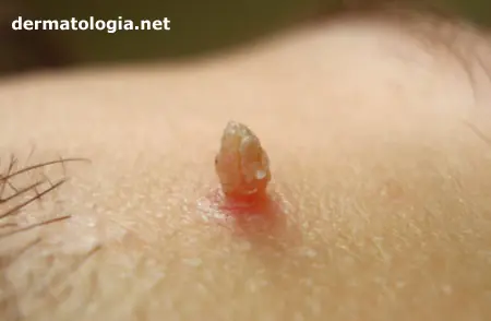 Virus De Papiloma = CANCER - Si tienes esto podrías morir