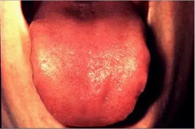 Cancer de Lengua