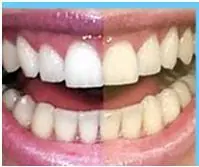 Cómo blanquear los dientes