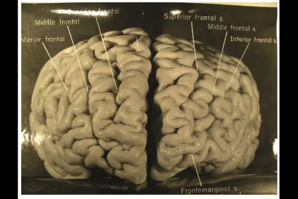 Fotografias del cerebro de Einstein un cerebro inusual