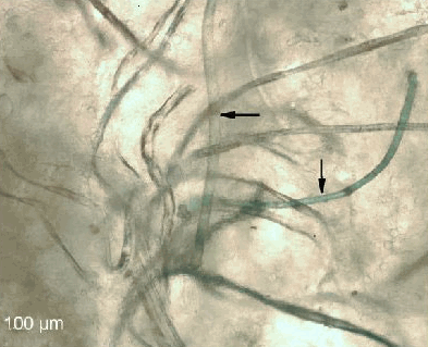 La enfermedad de Morgellons