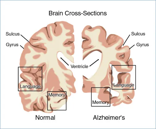 El Alzheimer podría triplicarse en los próximos años.