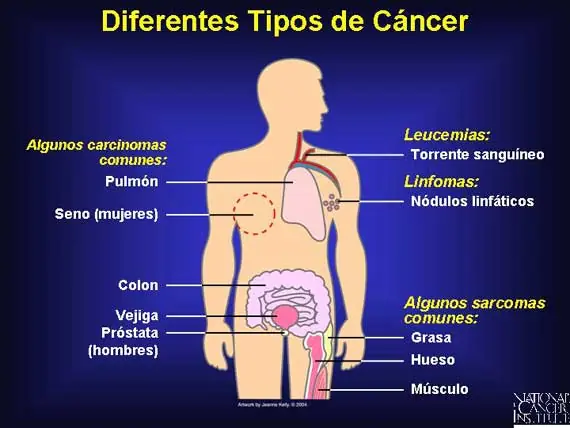 La cura contra el Cancer: La Vitamina C