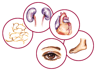Diabetes mellitus y sus complicaciones