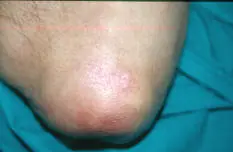 Psoriasis: Todo lo que querias saber
