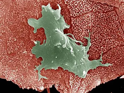 ¿Qué es la Tricomoniasis o vaginitis venérea?