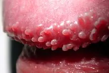 Papulas perladas (granitos en el glande del pene)