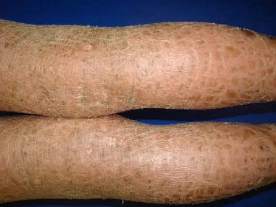 Ictiosis (La enfermedad de la piel de pez)