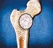 Info | Cancer de huesos