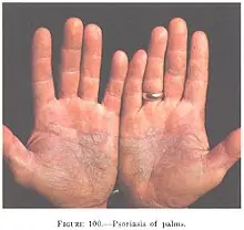 La Psoriasis No Se Cura. Pero Existe Tratamiento..