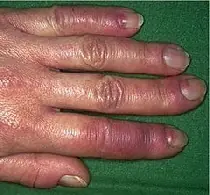 Que Son Los Sabañones