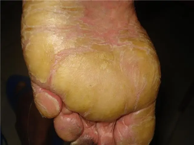Hongos en los pies: eliminalos sí o sí...