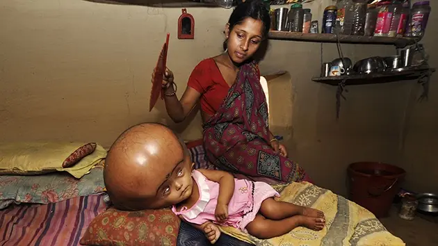 Niña india con la cabeza hinchada, a la espera de un milagr