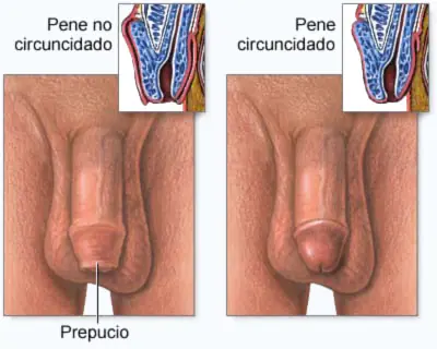 Fimosis,algo que afecta a muchisimas personas!