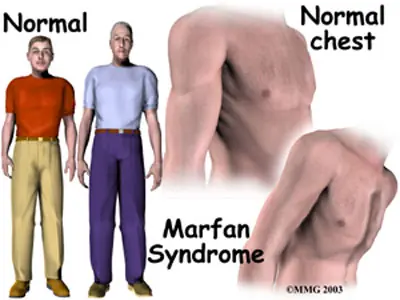 Síndrome de Marfan