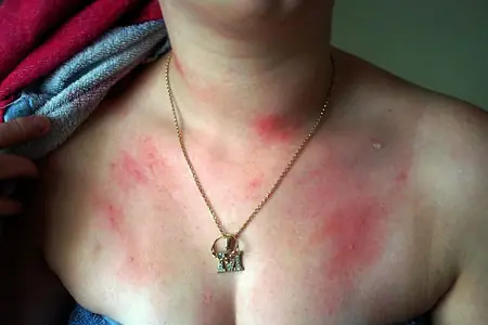 Mujer alergica al agua
