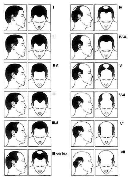 Como saber si tu pelo tiene remedio o quedarás calvo