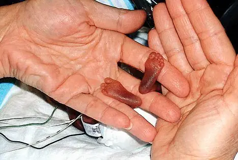 El bebé mas pequeño del mundo