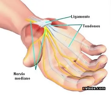 Cuida tu mano del Síndrome De Túnel Carpiano Bilateral