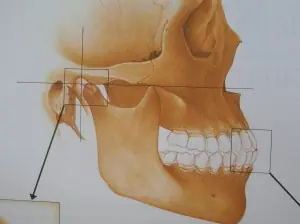 Dolor en la articulación de la mandíbula, A.T.M.