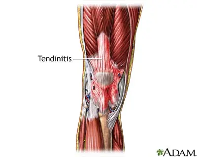 Tendinitis: prevenir y rehabilitar